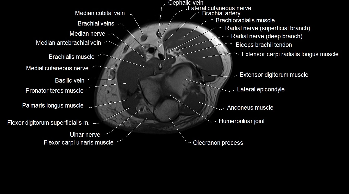 Upper arm( humerus) cross section anatomy MRI 3T axial image 56.webp